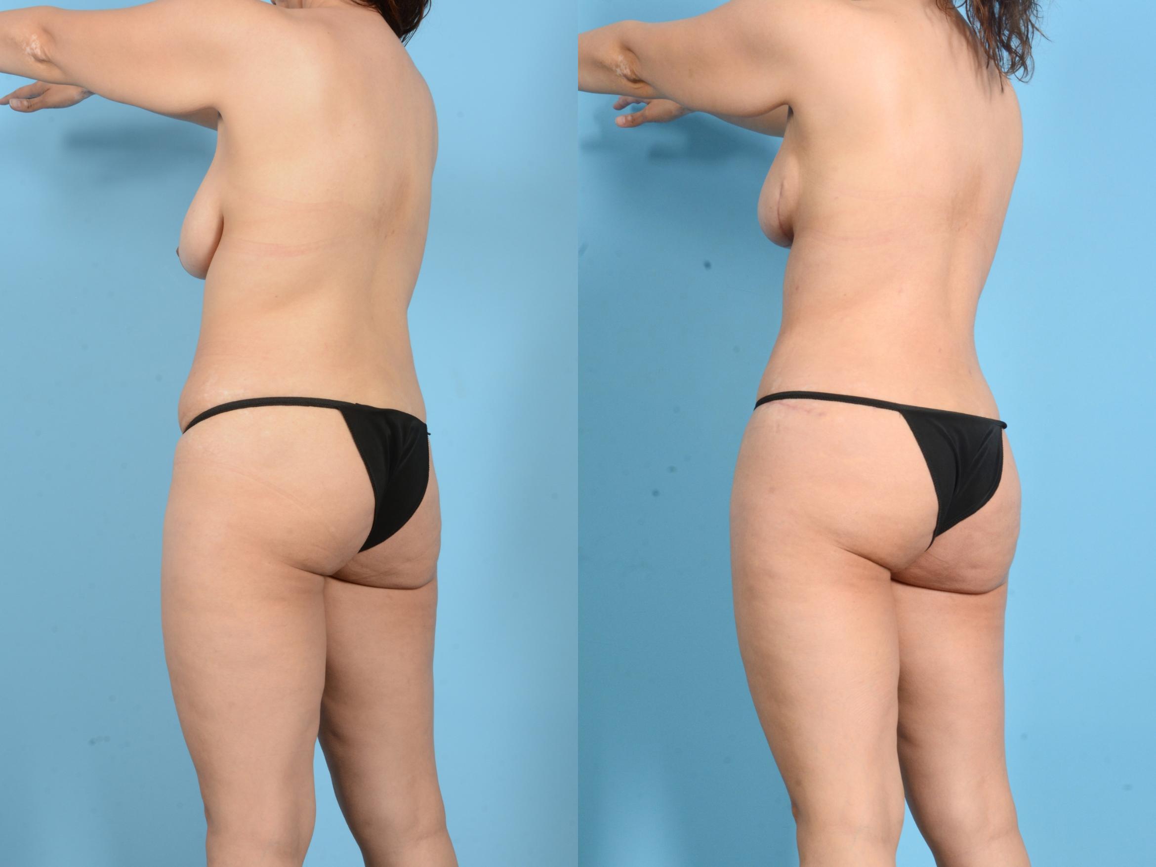 Before & After Mommy Makeover Case 18150 Left Back Oblique View in Houston, TX