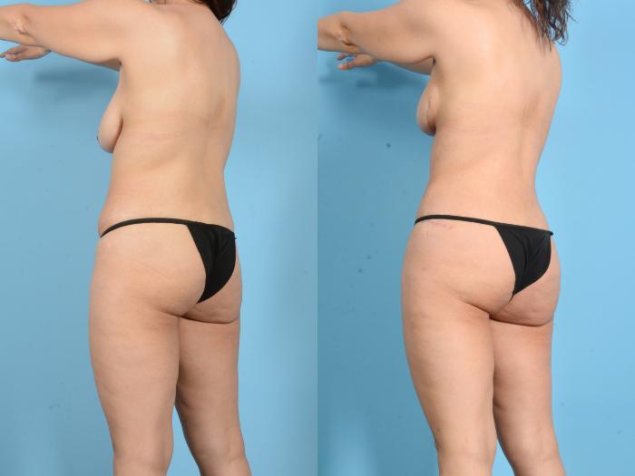 Before & After Mommy Makeover Case 18150 Left Back Oblique View in Houston, TX