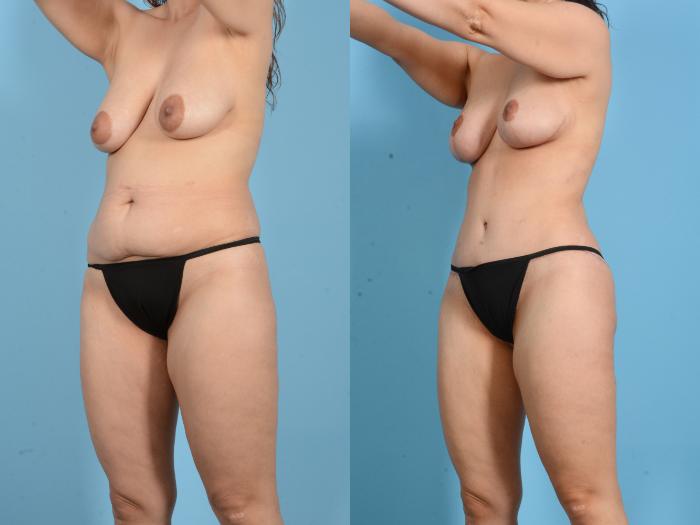 Before & After Mommy Makeover Case 18153 Left Oblique (Front) View in Houston, TX