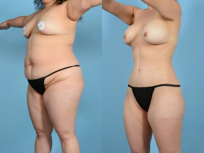 Before & After Mommy Makeover Case 18167 Left Oblique View in Houston, TX