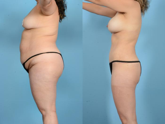 Before & After Mommy Makeover Case 18167 Left Side View in Houston, TX