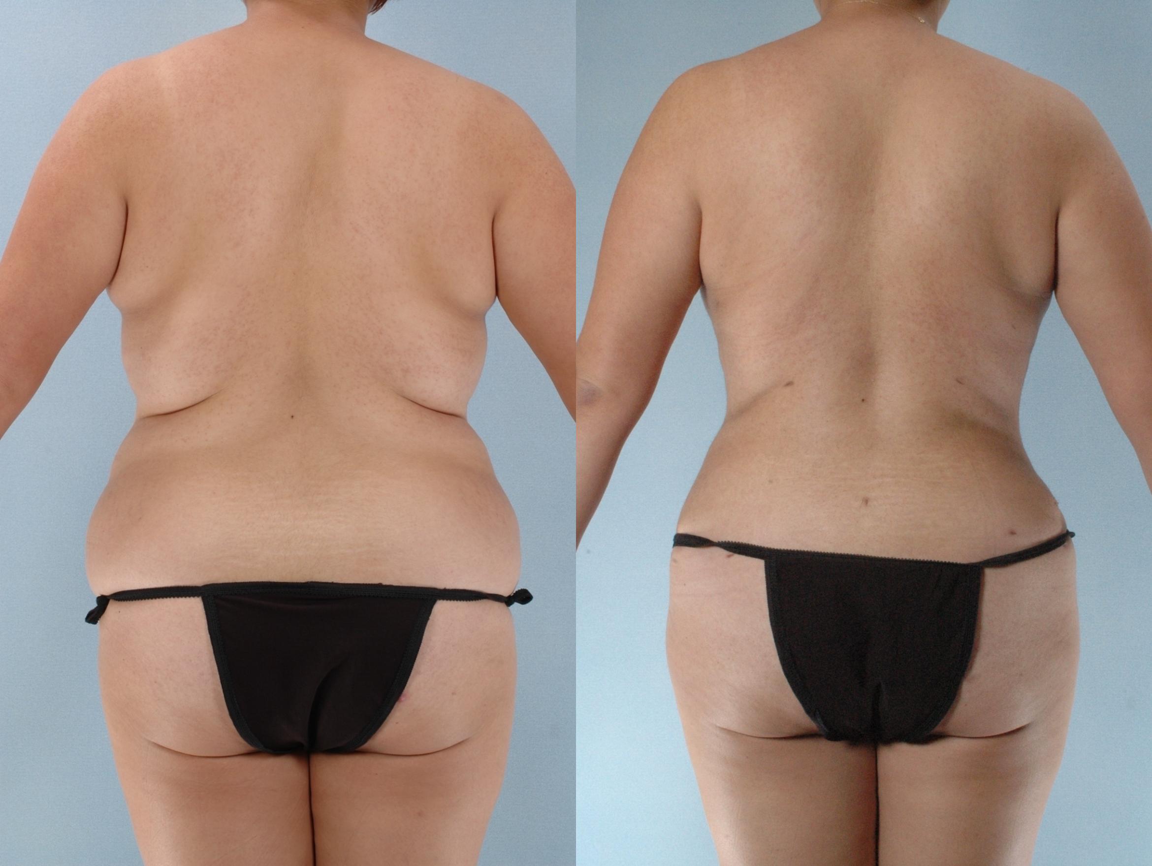 Before & After Mommy Makeover Case 613875210000 Back View in Houston, TX
