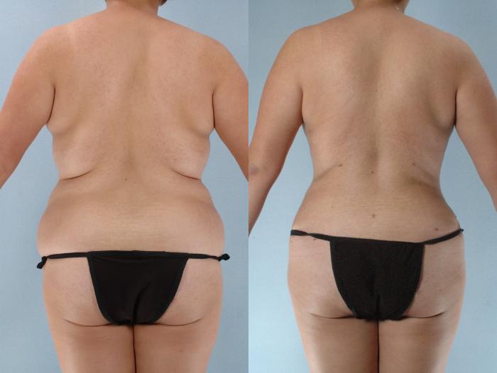 Before & After Mommy Makeover Case 613875210000 Back View in Houston, TX