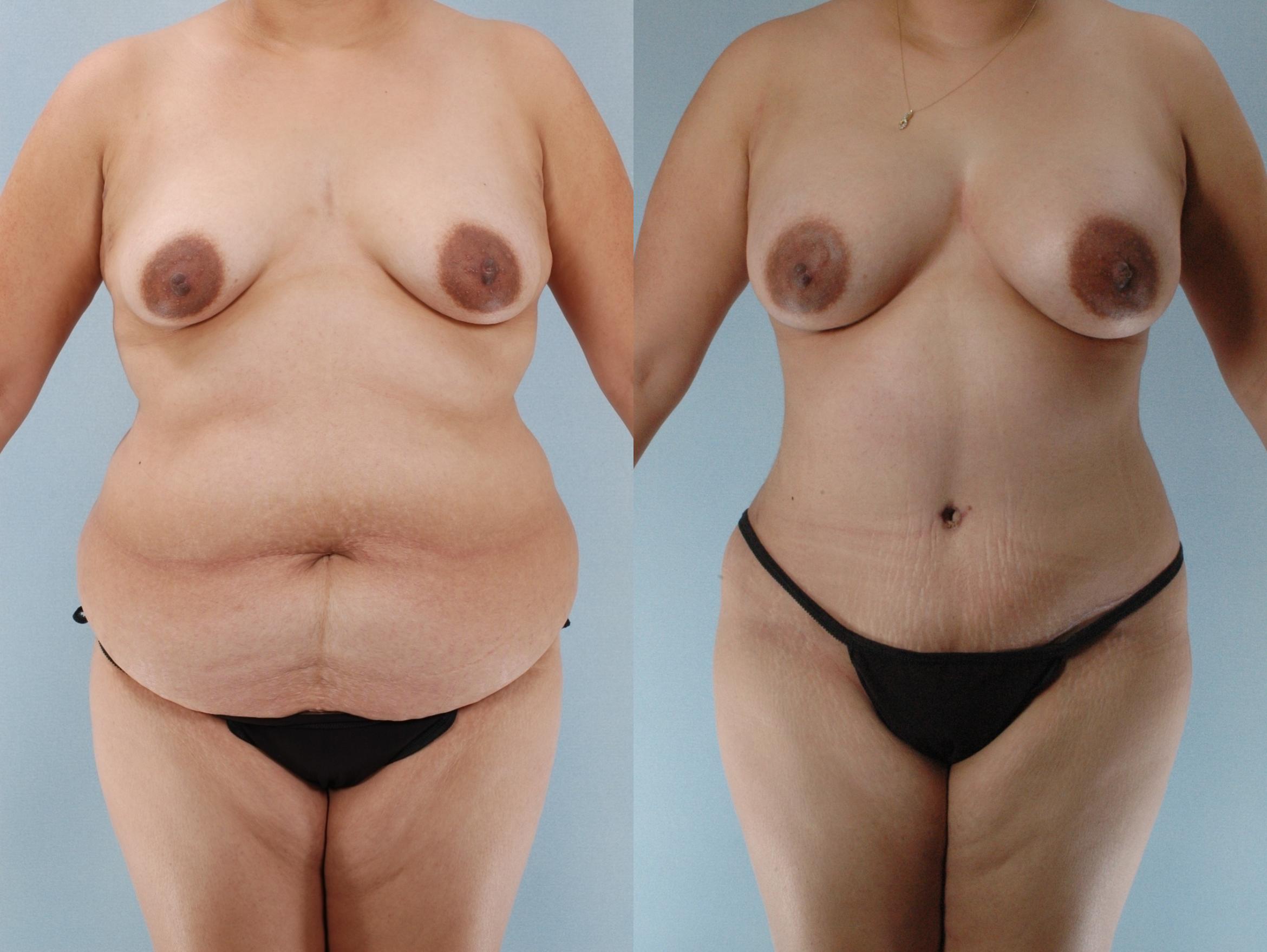 Before & After Mommy Makeover Case 613875210000 Front View in Houston, TX