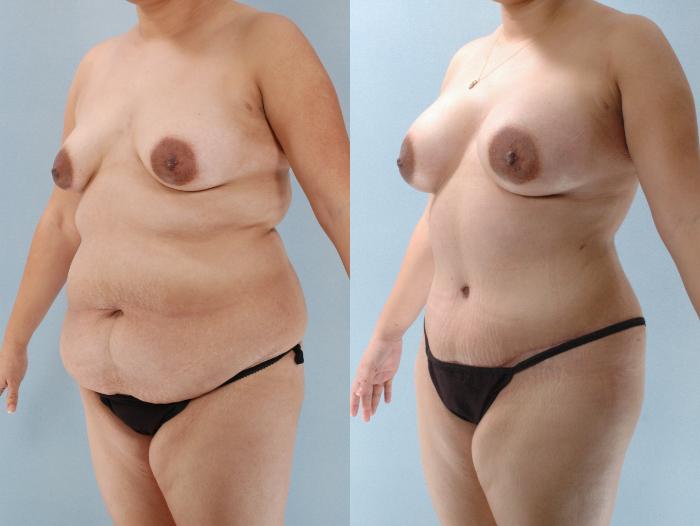 Before & After Mommy Makeover Case 613875210000 Left Oblique View in Houston, TX