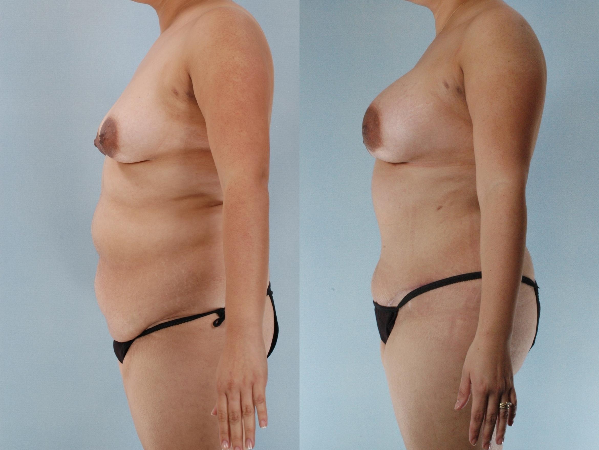 Before & After Mommy Makeover Case 613875210000 Left Side View in Houston, TX