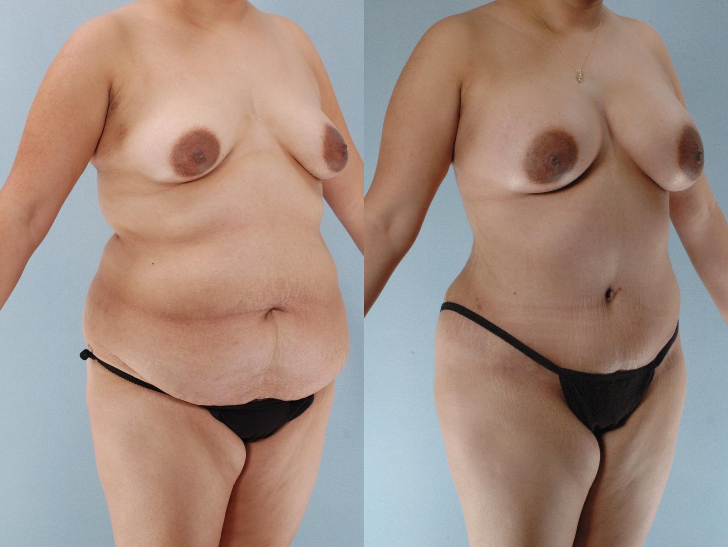 Before & After Mommy Makeover Case 613875210000 Right Oblique View in Houston, TX