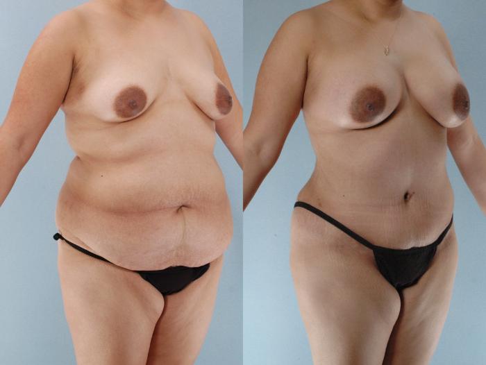 Before & After Mommy Makeover Case 613875210000 Right Oblique View in Houston, TX