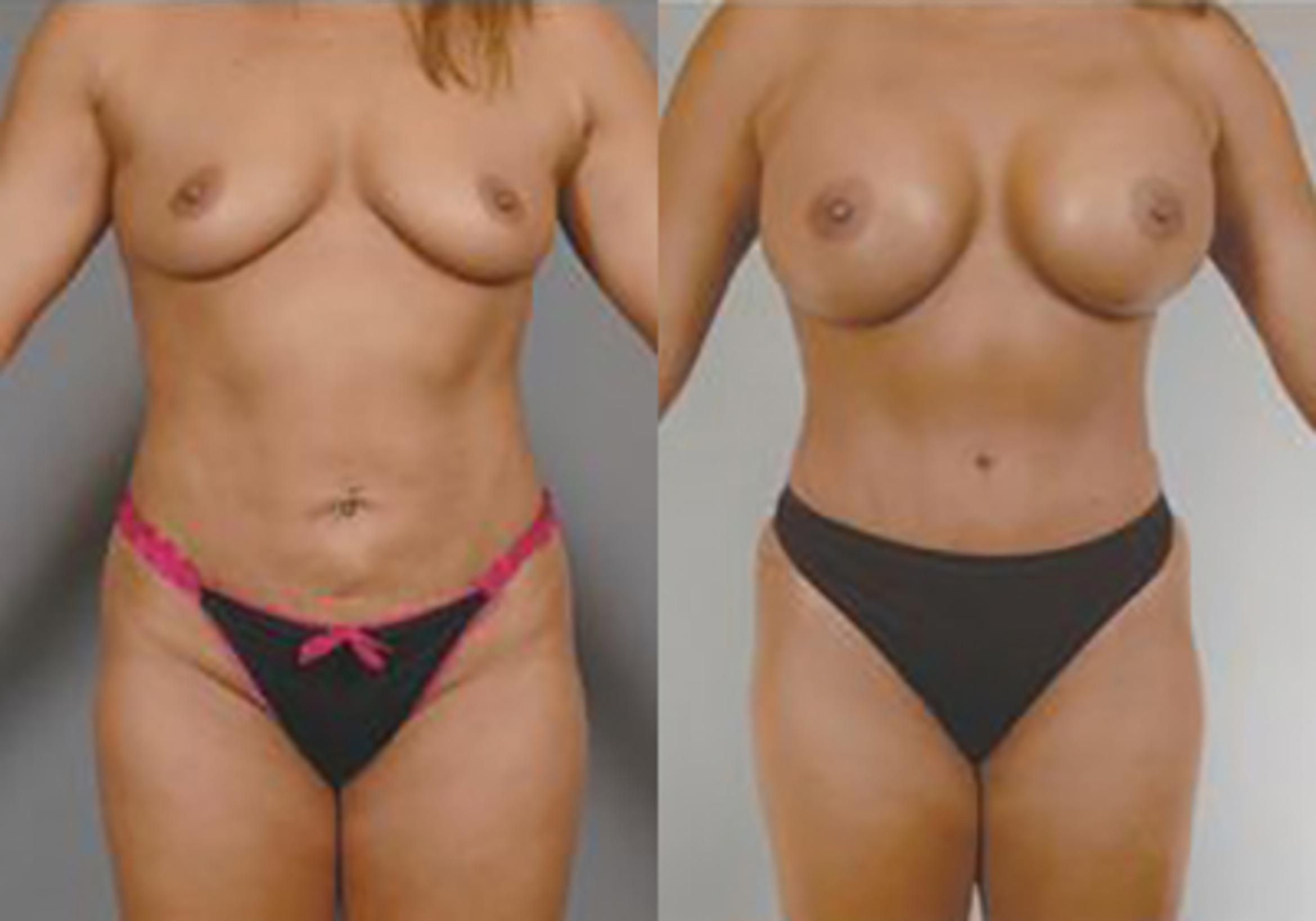 Before & After Mommy Makeover Case 709999 View 1 View in Houston, TX