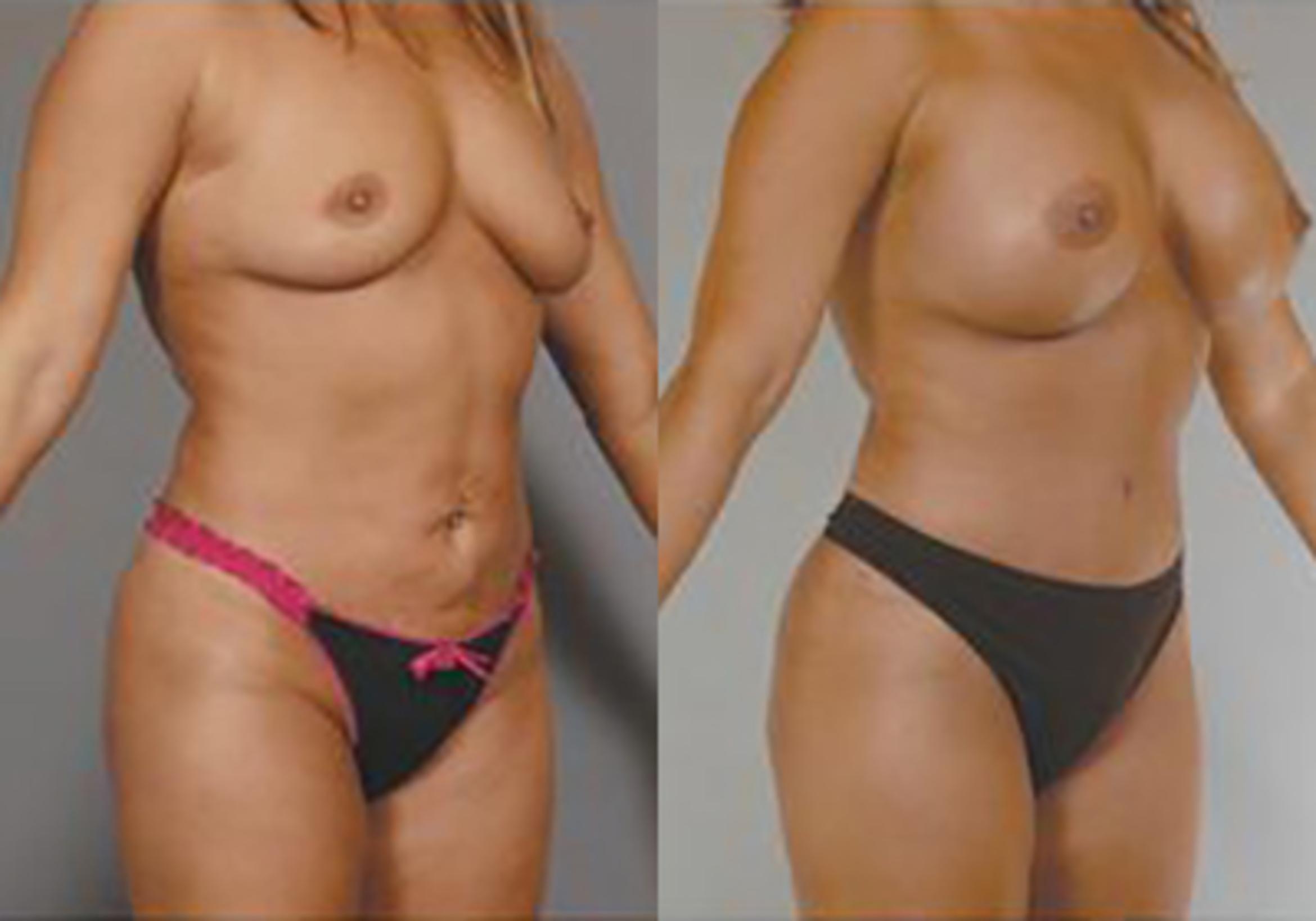 Before & After Mommy Makeover Case 709999 View 2 View in Houston, TX