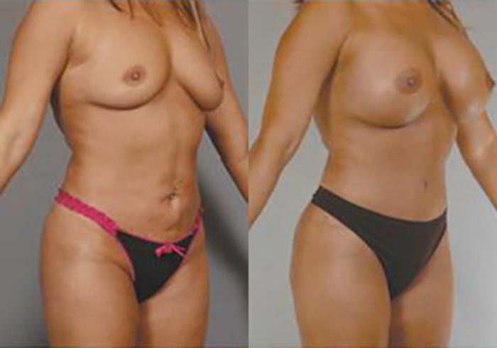 Before & After Mommy Makeover Case 709999 View 2 View in Houston, TX