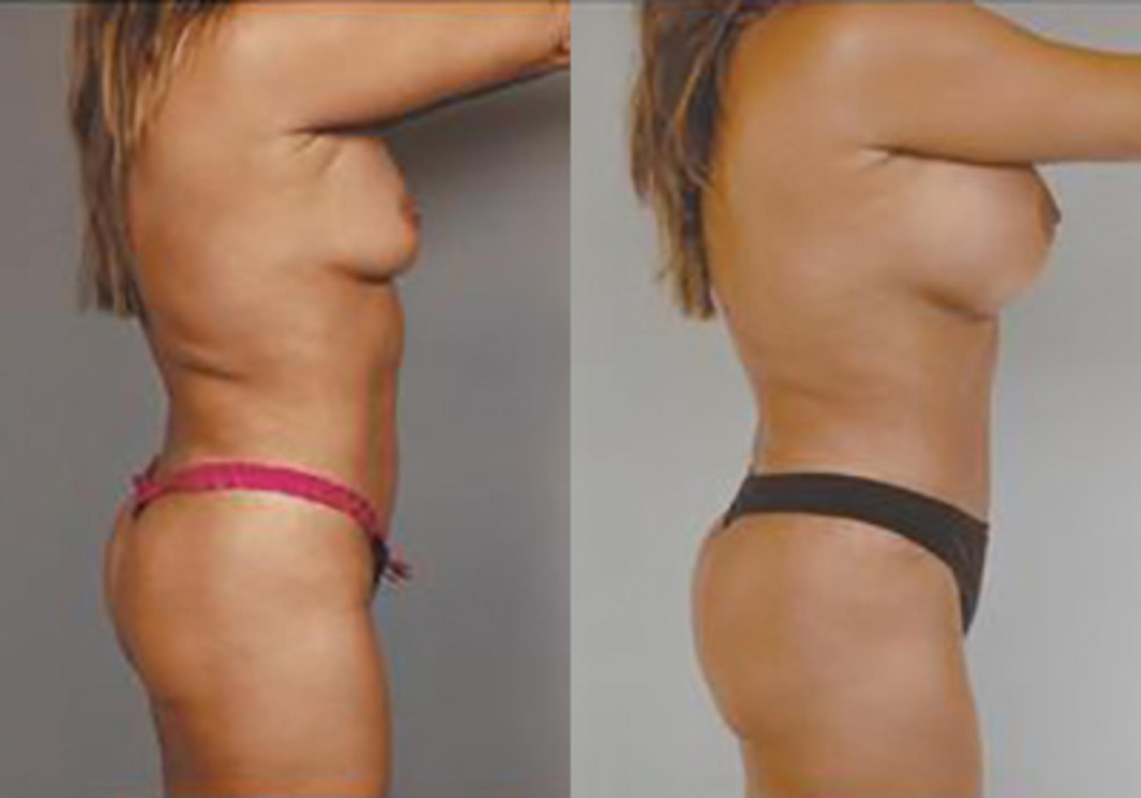 Before & After Mommy Makeover Case 709999 View 3 View in Houston, TX