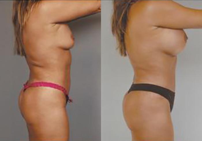 Before & After Mommy Makeover Case 709999 View 3 View in Houston, TX