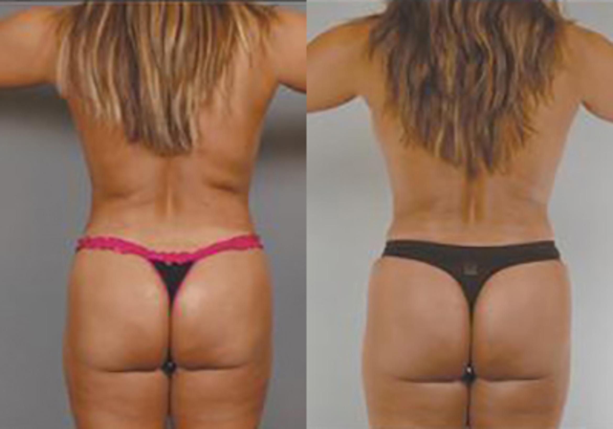 Before & After Mommy Makeover Case 709999 View 4 View in Houston, TX