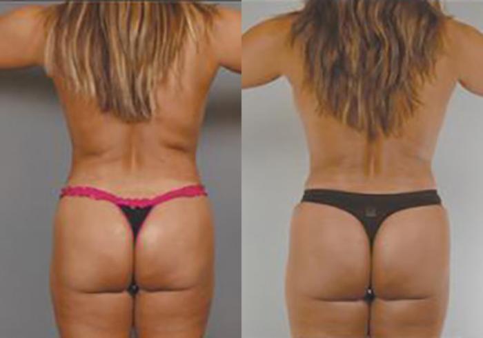 Before & After Mommy Makeover Case 709999 View 4 View in Houston, TX