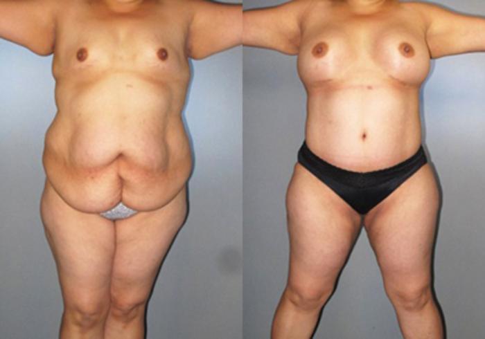 Before & After Mommy Makeover Case 82899998 View 1 View in Houston, TX