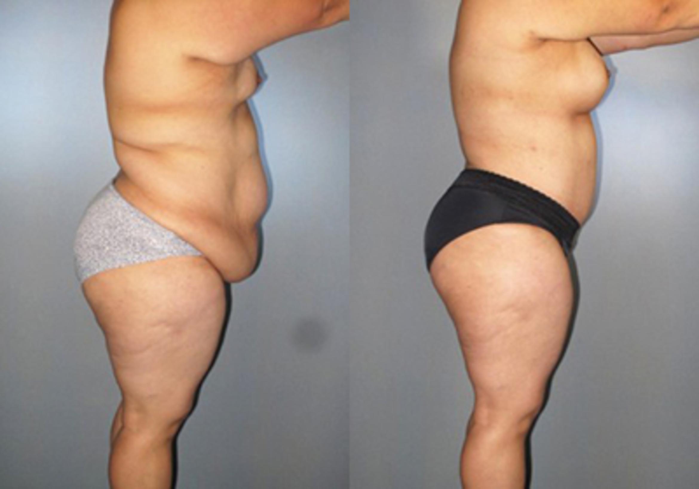 Before & After Mommy Makeover Case 82899998 View 3 View in Houston, TX