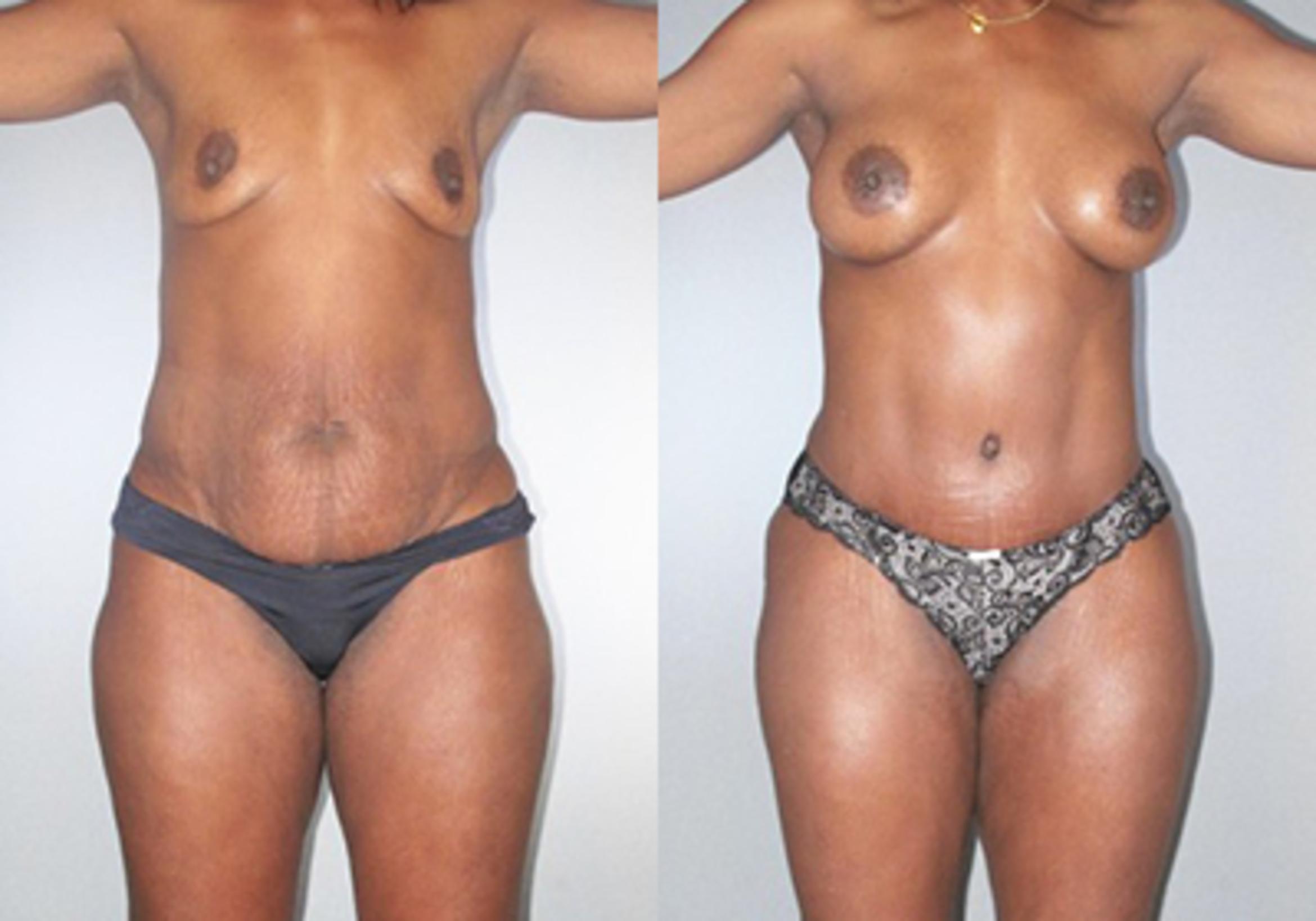 Before & After Mommy Makeover Case 92519999 View 1 View in Houston, TX