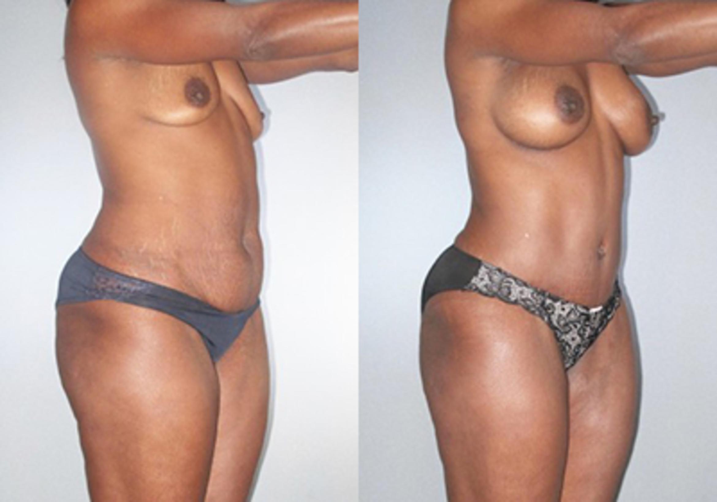 Before & After Mommy Makeover Case 92519999 View 2 View in Houston, TX