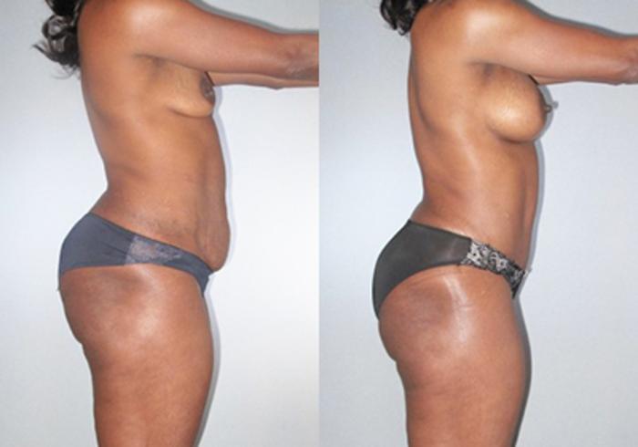 Before & After Mommy Makeover Case 92519999 View 3 View in Houston, TX