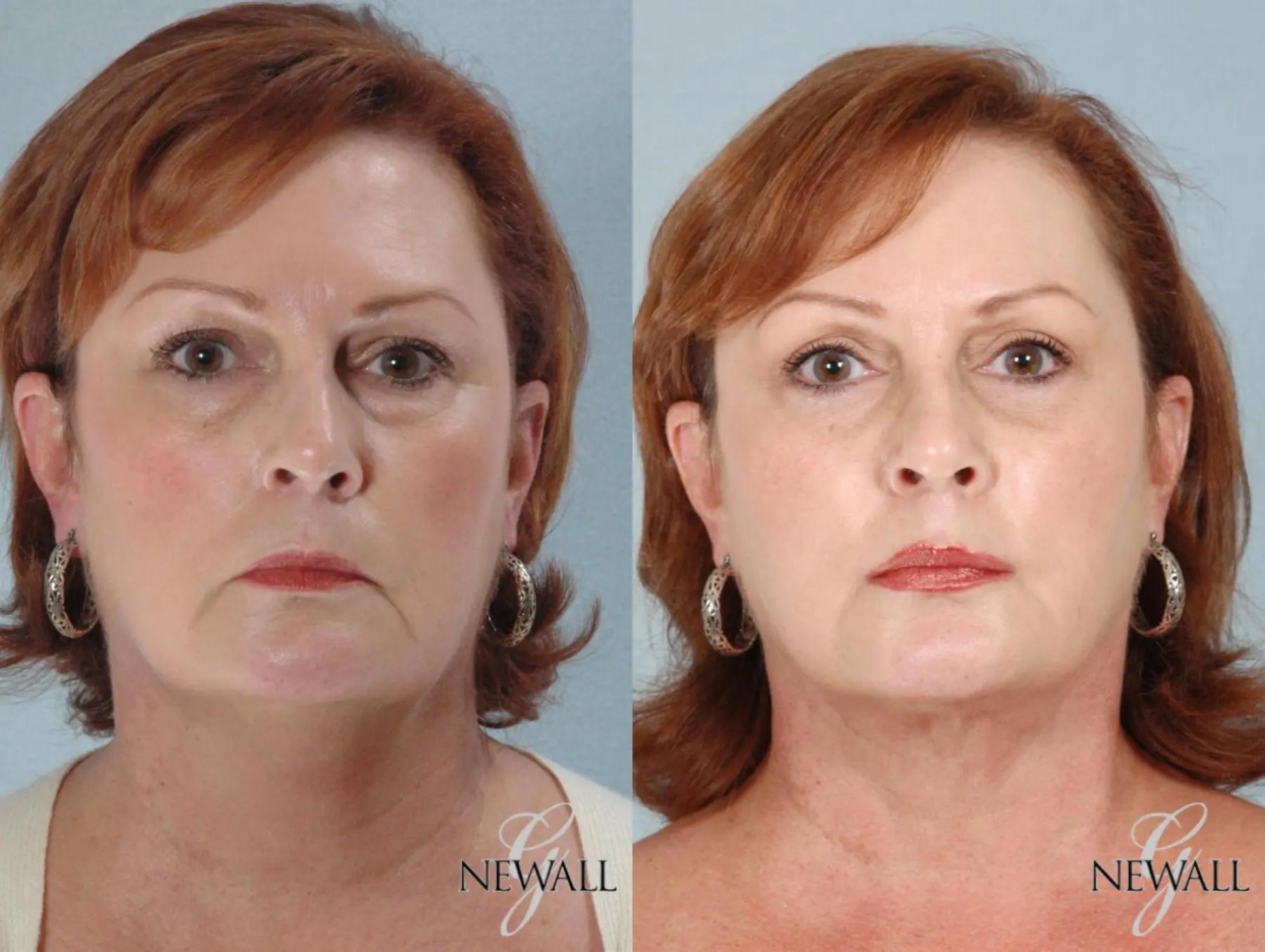 Before & After Neck Liposuction Case 17457 View 1 View in Houston, TX