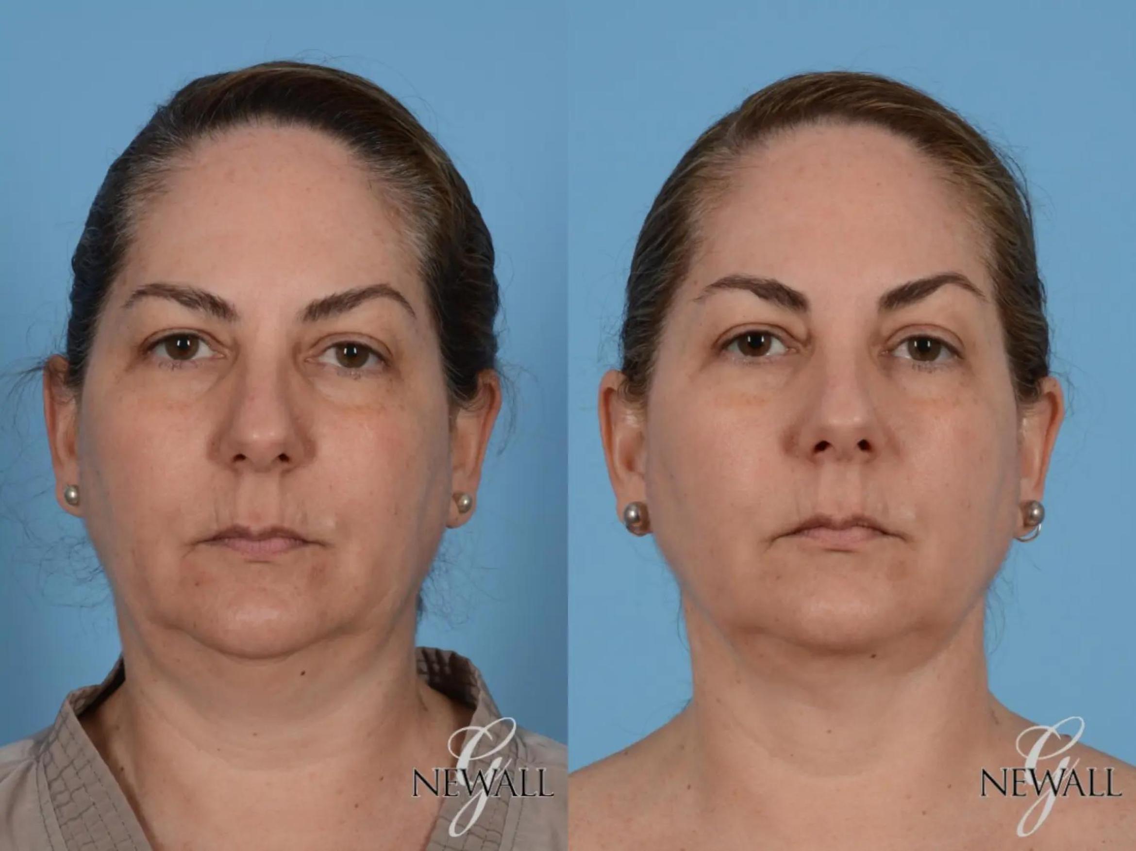 Before & After Neck Liposuction Case 17562 View 1 View in Houston, TX