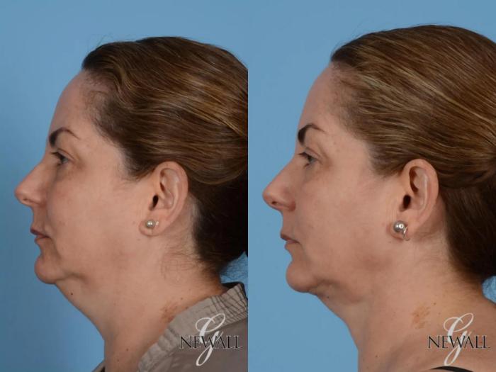 Before & After Neck Liposuction Case 17562 View 5 View in Houston, TX