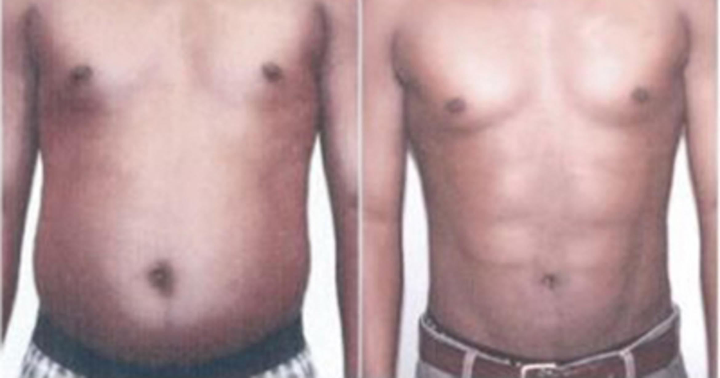 Before & After Neck Liposuction Case 5319 View 1 View in Houston, TX