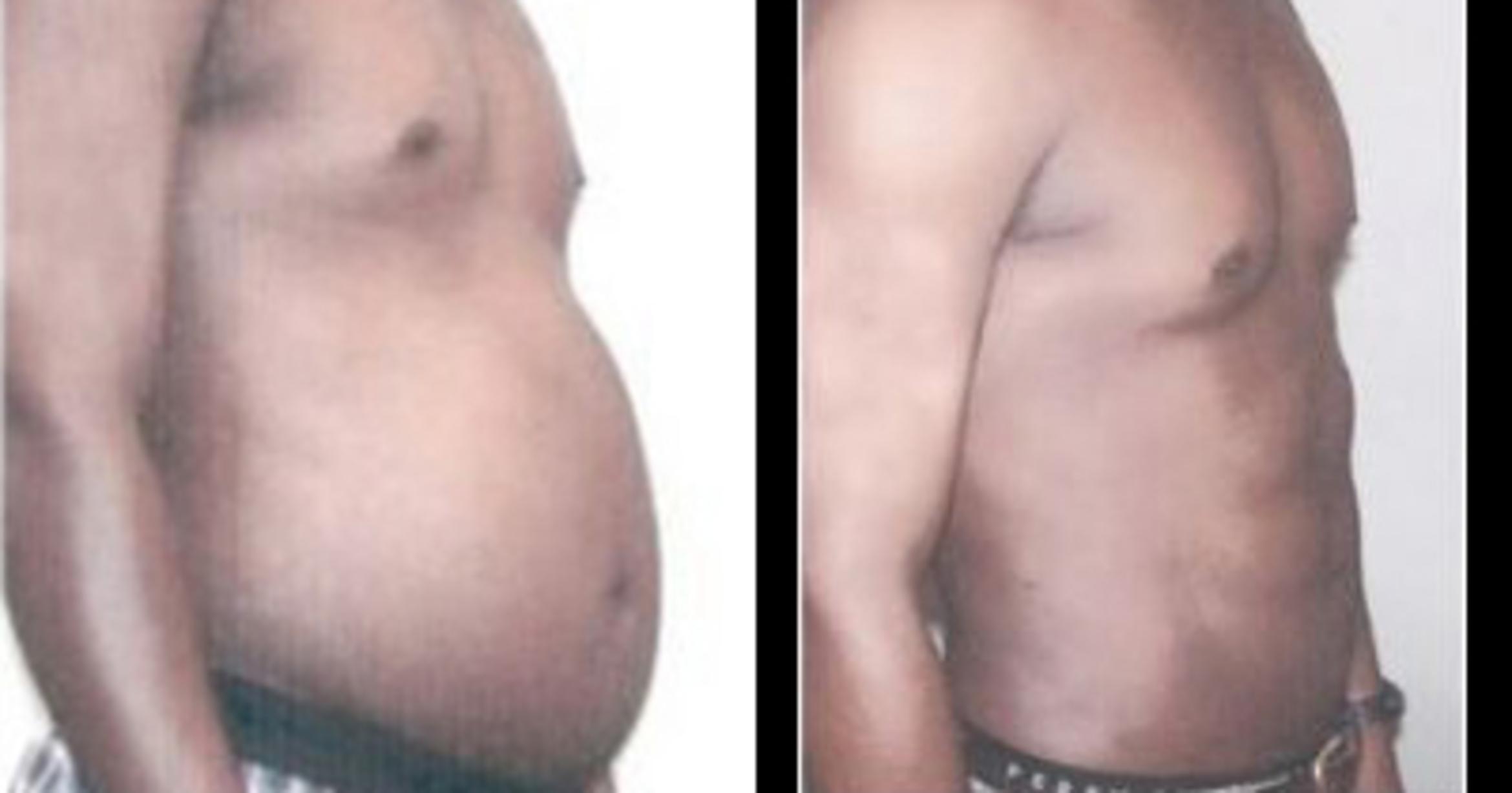 Before & After Neck Liposuction Case 5319 View 2 View in Houston, TX