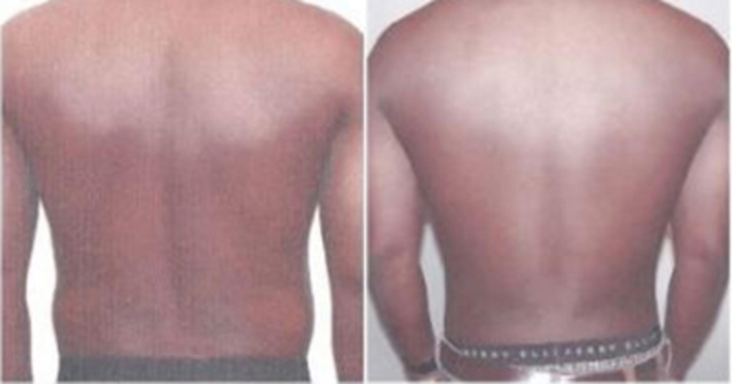 Before & After Neck Liposuction Case 5319 View 3 View in Houston, TX