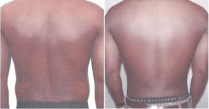 Before & After Neck Liposuction Case 5319 View 3 View in Houston, TX