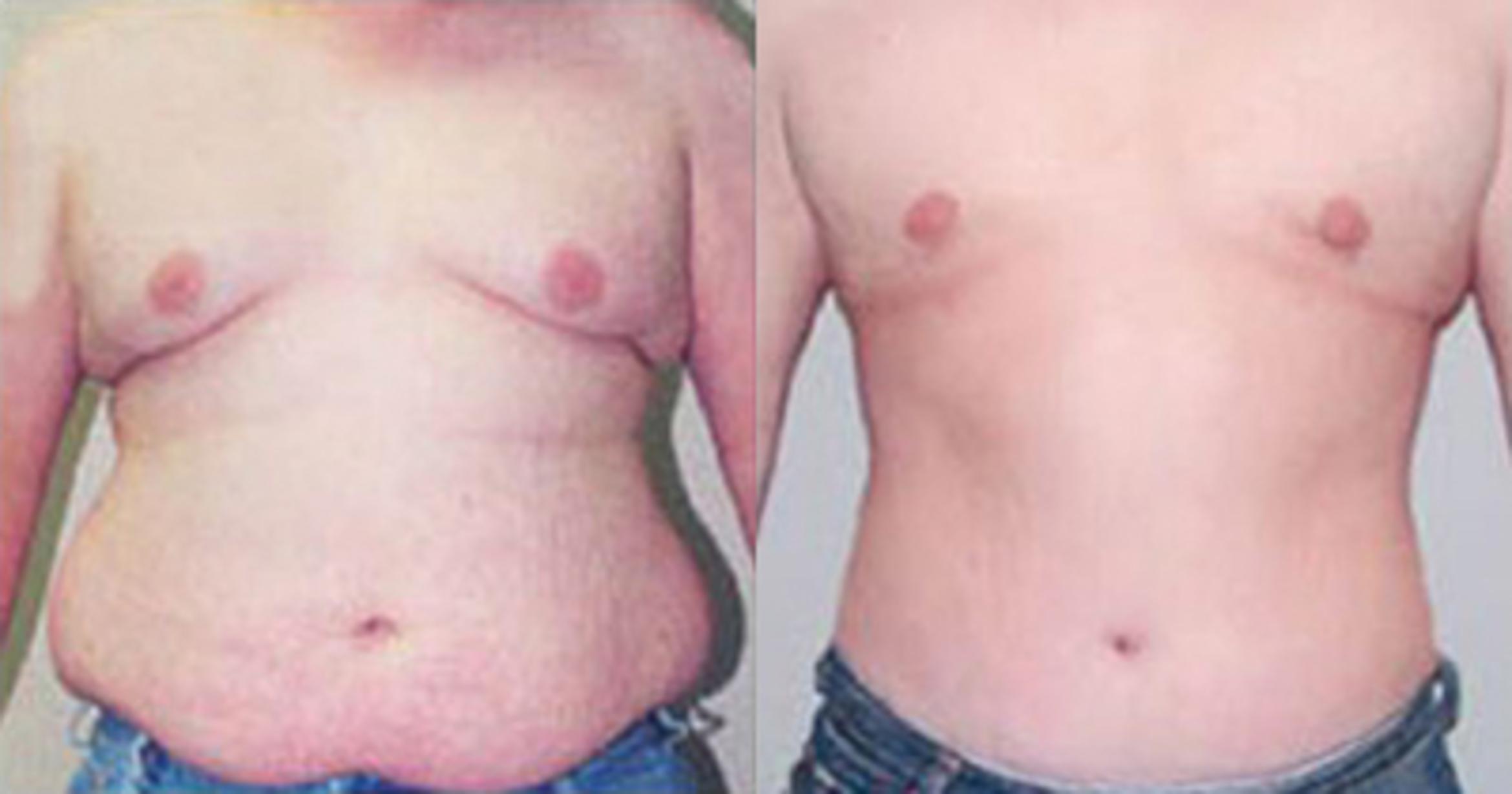 Before & After Neck Liposuction Case 53329999 View 1 View in Houston, TX