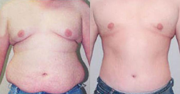 Before & After Neck Liposuction Case 53329999 View 1 View in Houston, TX