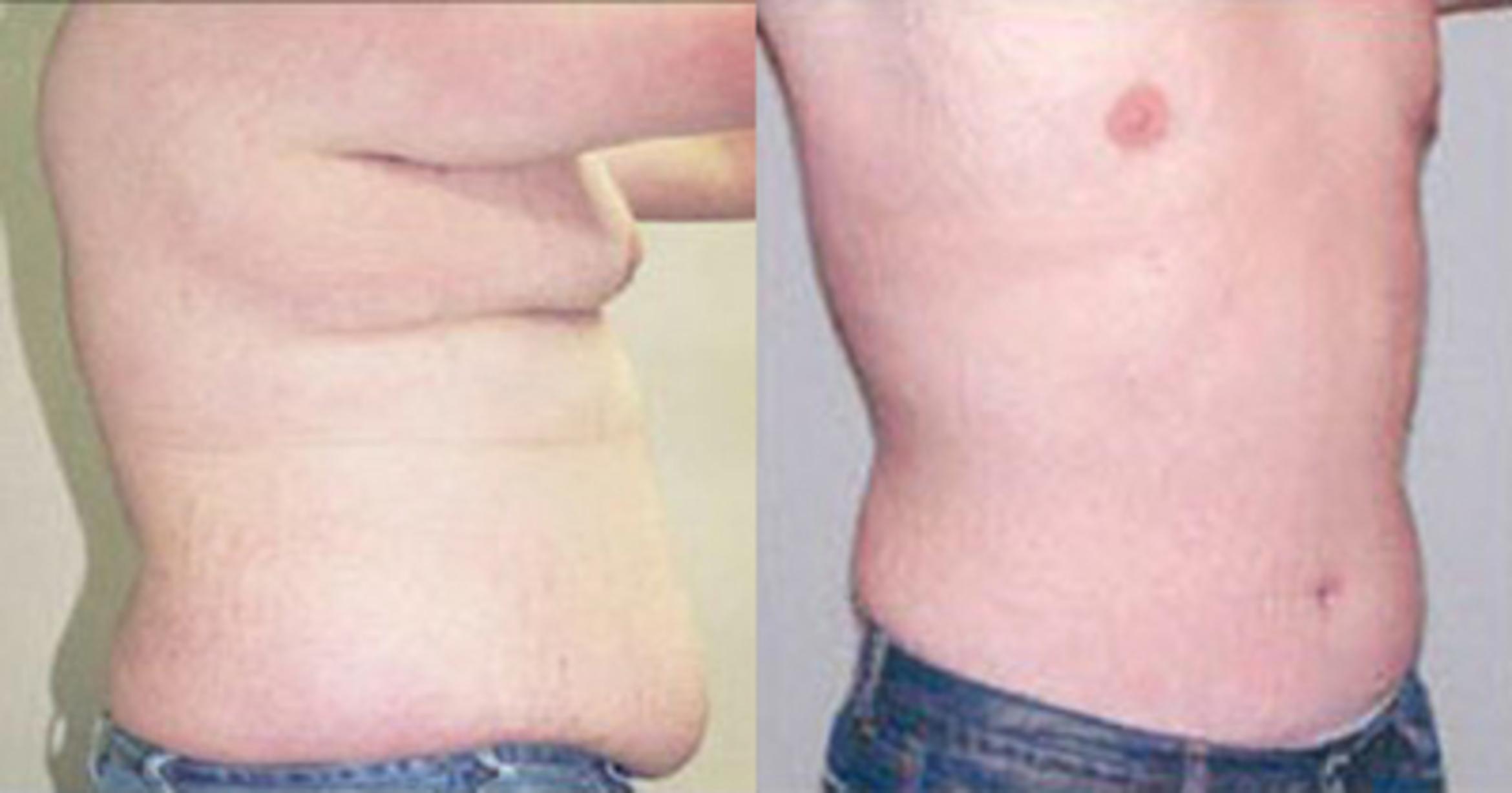 Before & After Neck Liposuction Case 53329999 View 2 View in Houston, TX