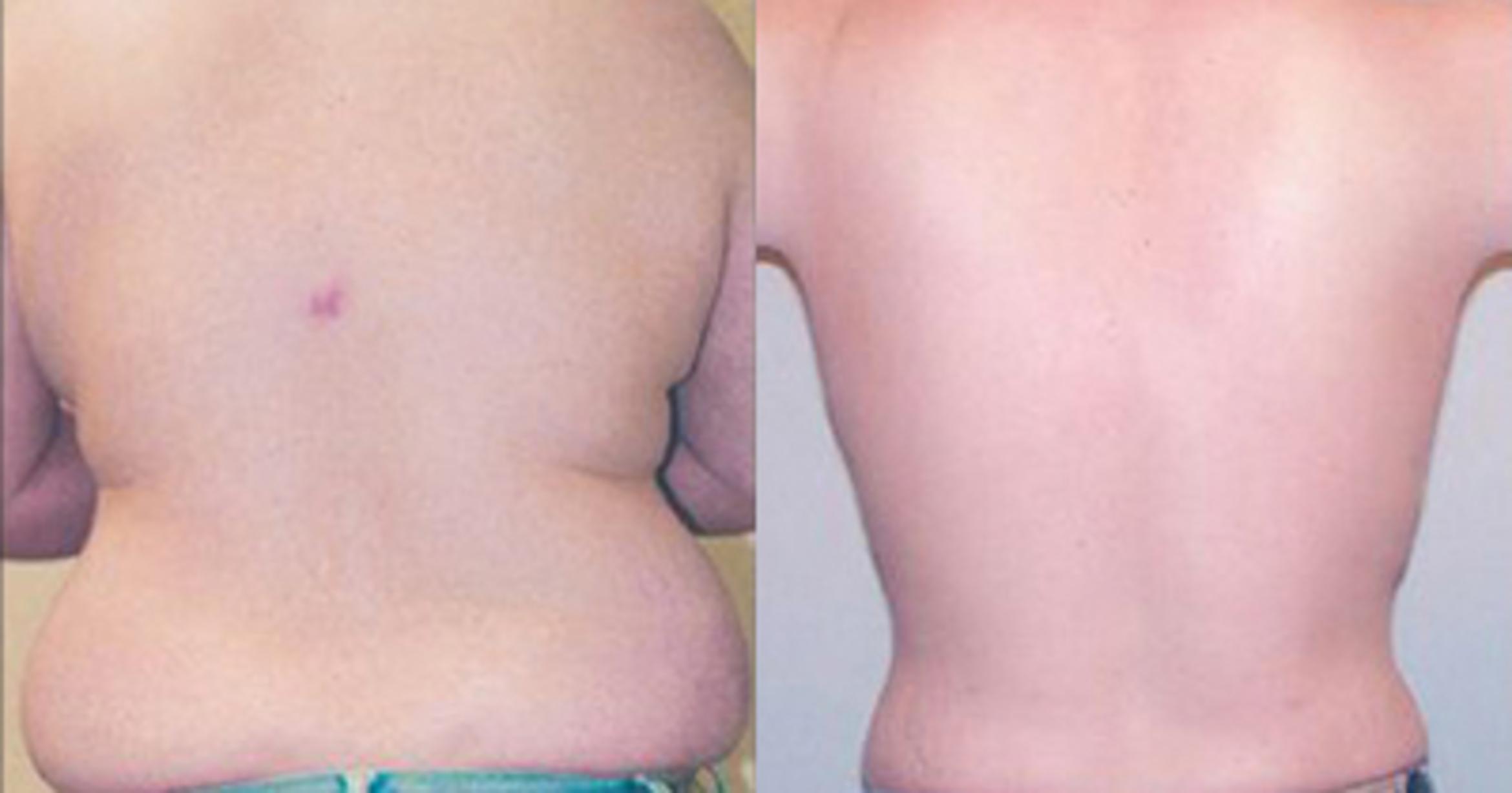 Before & After Neck Liposuction Case 53329999 View 3 View in Houston, TX