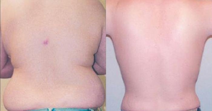 Before & After Neck Liposuction Case 53329999 View 3 View in Houston, TX