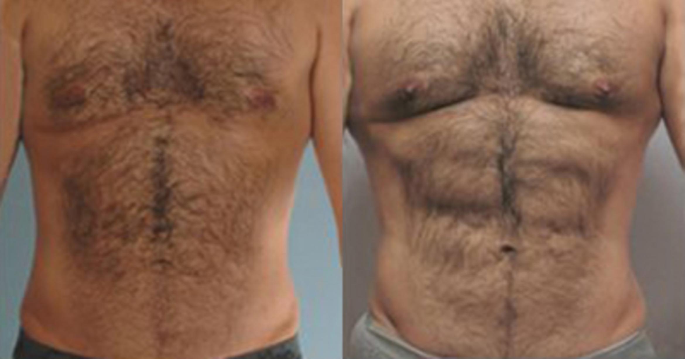 Before & After Neck Liposuction Case 5364 View 1 View in Houston, TX