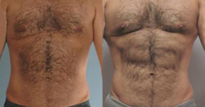 Before & After Neck Liposuction Case 5364 View 1 View in Houston, TX