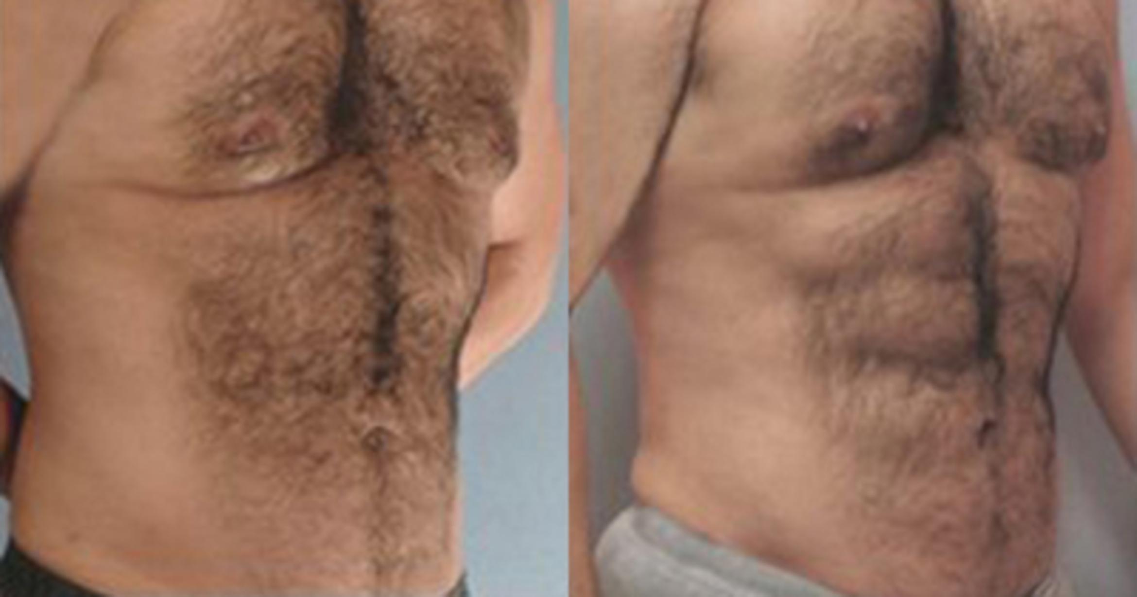 Before & After Neck Liposuction Case 5364 View 2 View in Houston, TX