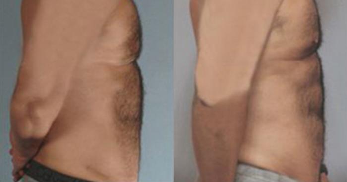 Before & After Neck Liposuction Case 5364 View 3 View in Houston, TX