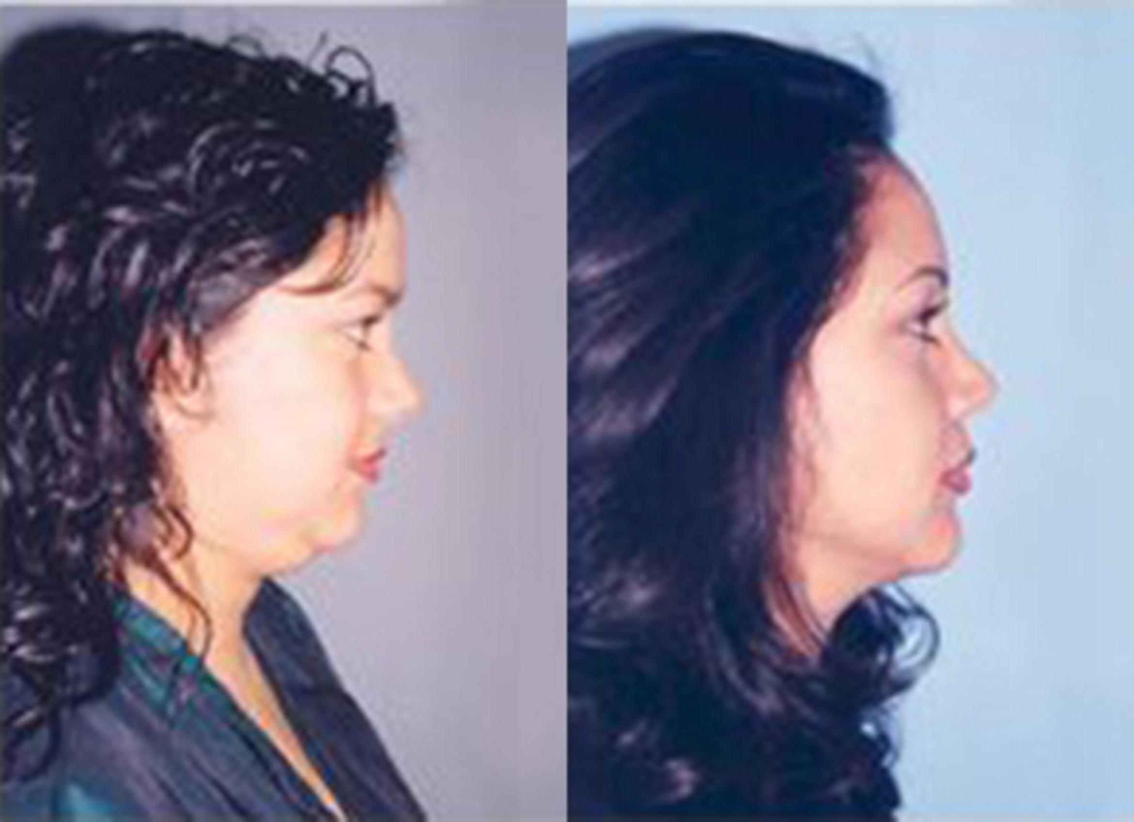Before & After Neck Liposuction Case 5695 View 2 View in Houston, TX