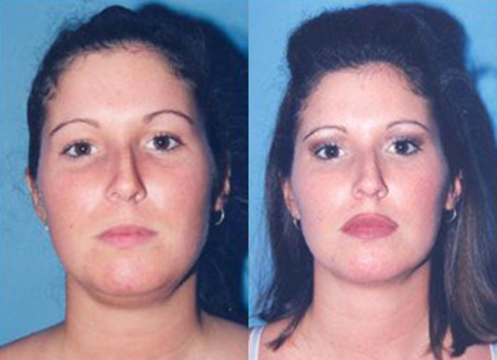 Before & After Neck Liposuction Case 5701 View 1 View in Houston, TX