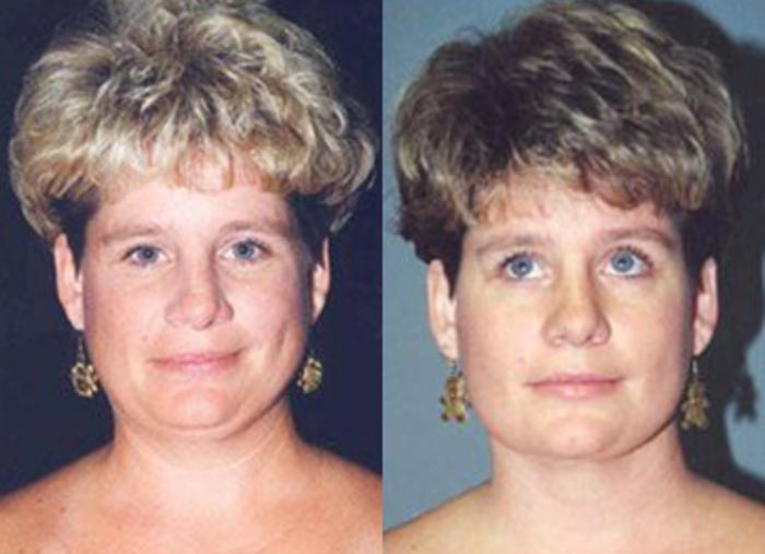 Before & After Neck Liposuction Case 5705 View 1 View in Houston, TX