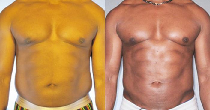 Before & After Neck Liposuction Case 91839999 View 1 View in Houston, TX