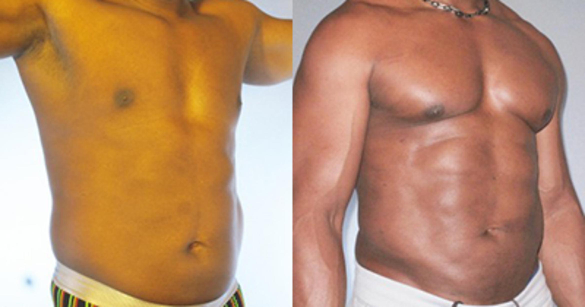 Before & After Neck Liposuction Case 91839999 View 2 View in Houston, TX