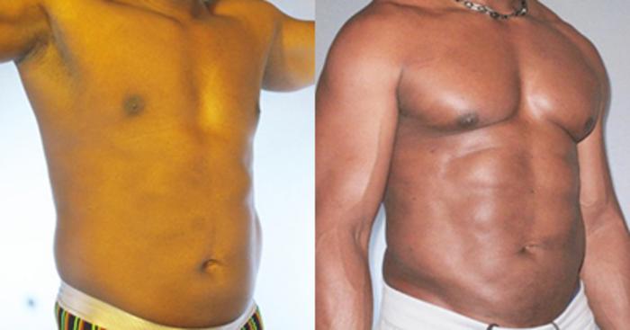 Before & After Neck Liposuction Case 91839999 View 2 View in Houston, TX