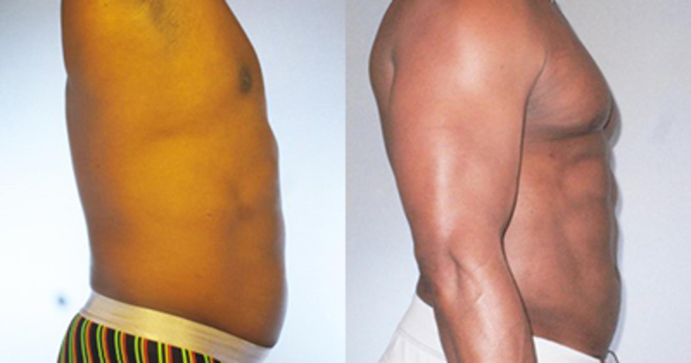 Before & After Neck Liposuction Case 91839999 View 3 View in Houston, TX