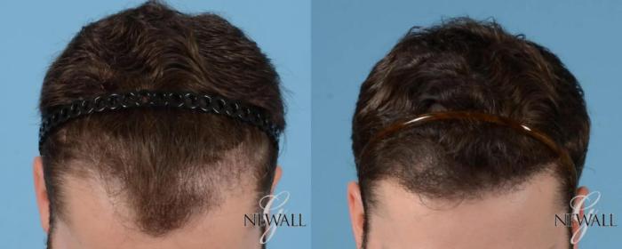 Before & After (NeoGraft) Hair Transplantation Case 16975 View 1 View in Houston, TX