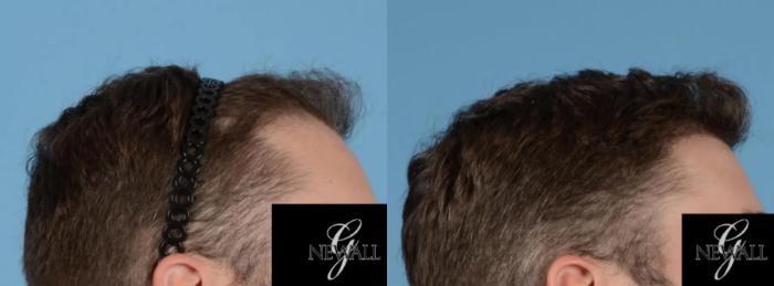 Before & After (NeoGraft) Hair Transplantation Case 16975 View 2 View in Houston, TX