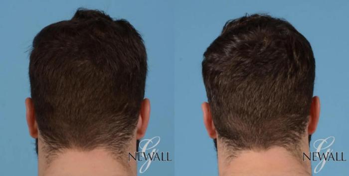 Before & After (NeoGraft) Hair Transplantation Case 16975 View 3 View in Houston, TX